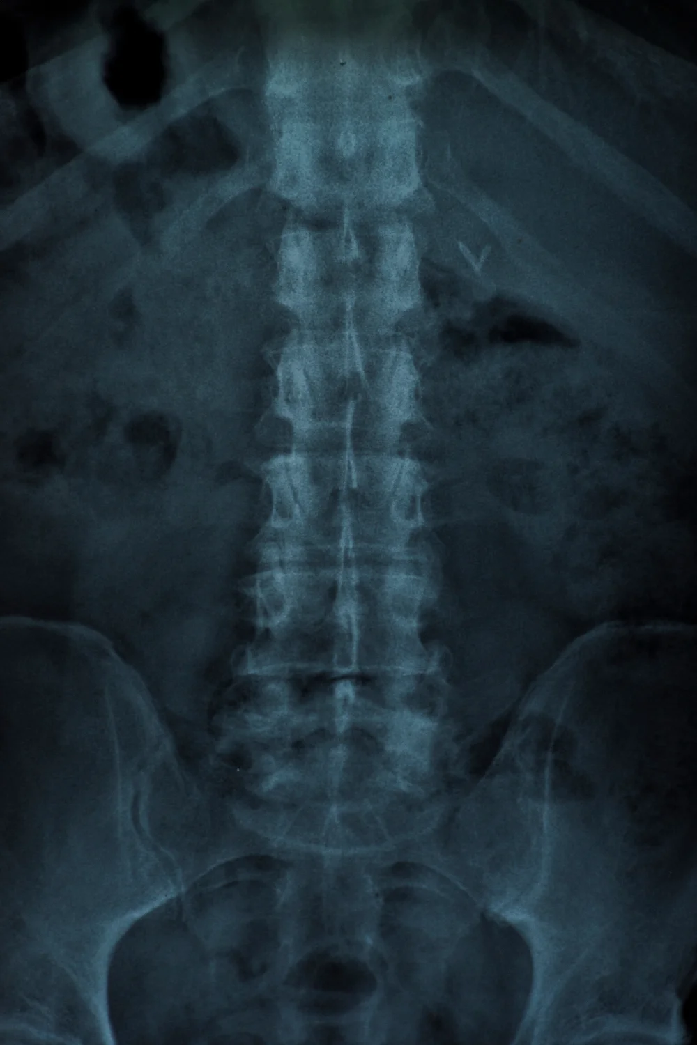 Raio X para estudos sobre neurocirúrgia